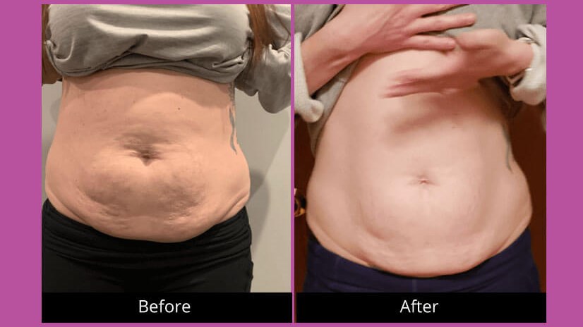 Belly Fat